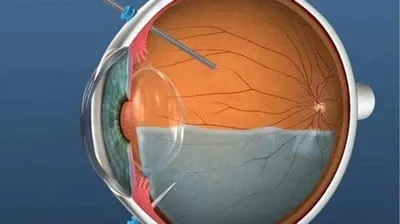 ماهو ثقب مركز الإبصار؟
